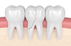 Способы, причины и лечение трещины в зубе