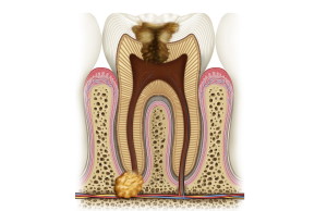 Что такое гранулема зуба