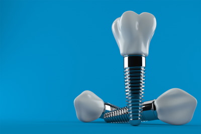 Что нужно знать перед имплантацией зубов?