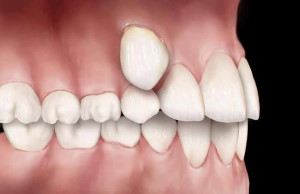 Причины, виды, лечение дистопии зубов