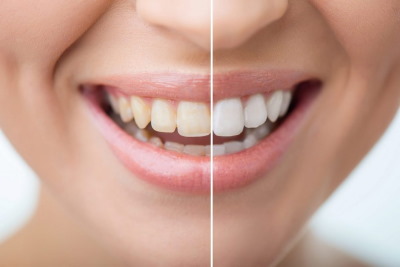 Как долго болят зубы после отбеливания