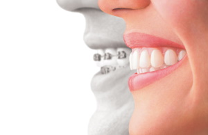 Современные методы в ортодонтии